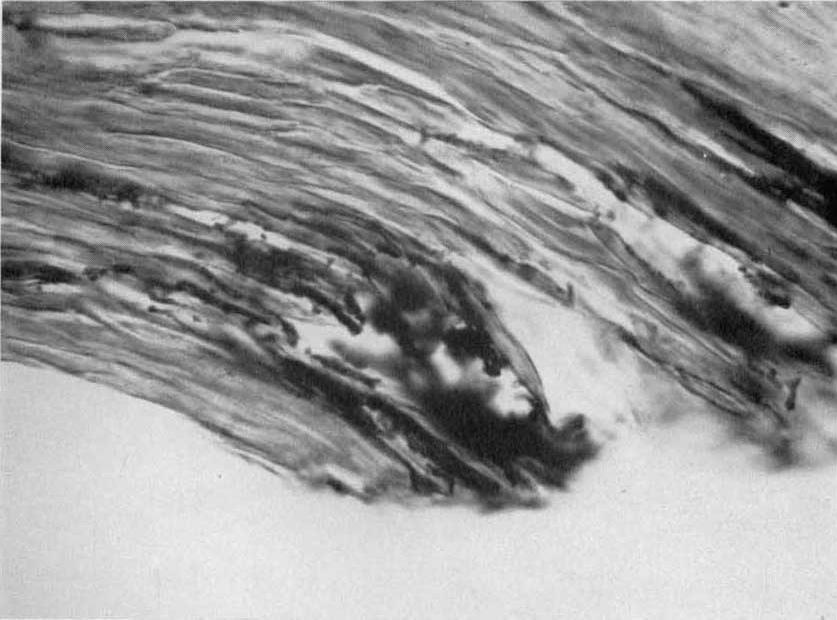 Magnification X 560. FIG. 4. Invasion of nail plate by T. mentagrophytes from free edge of nail clipping.