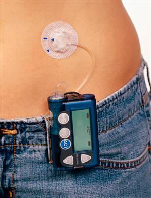 Continuous subcutaneous insulin infusion Worn on a belt Pump is connected