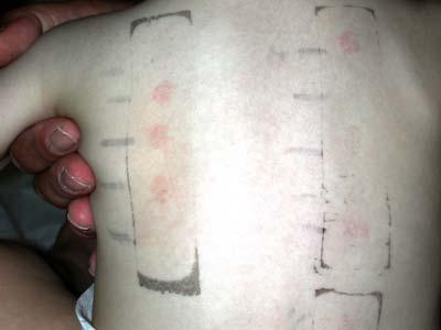 Atopy Patch Testing (ATP) Finn Chambers Using Allergy Testing to Guide