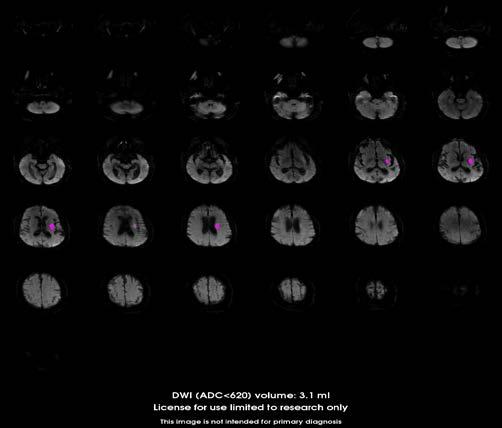 88 year old woman with L M1 occlusion, TLSW 22
