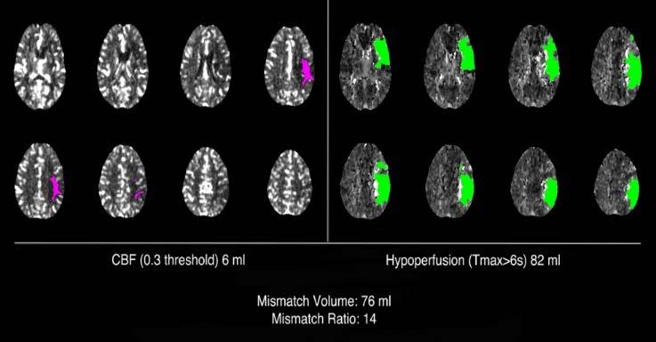 tandem MCA lesions) AND Target Mismatch Profile on CT perfusion or MRI