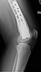 ** 3-Year Postoperative Follow-up At the 3-year follow-up, x-rays show that the bone graft material was completely resorbed and replaced by new bone growth (FIGURES 7A and 7B).
