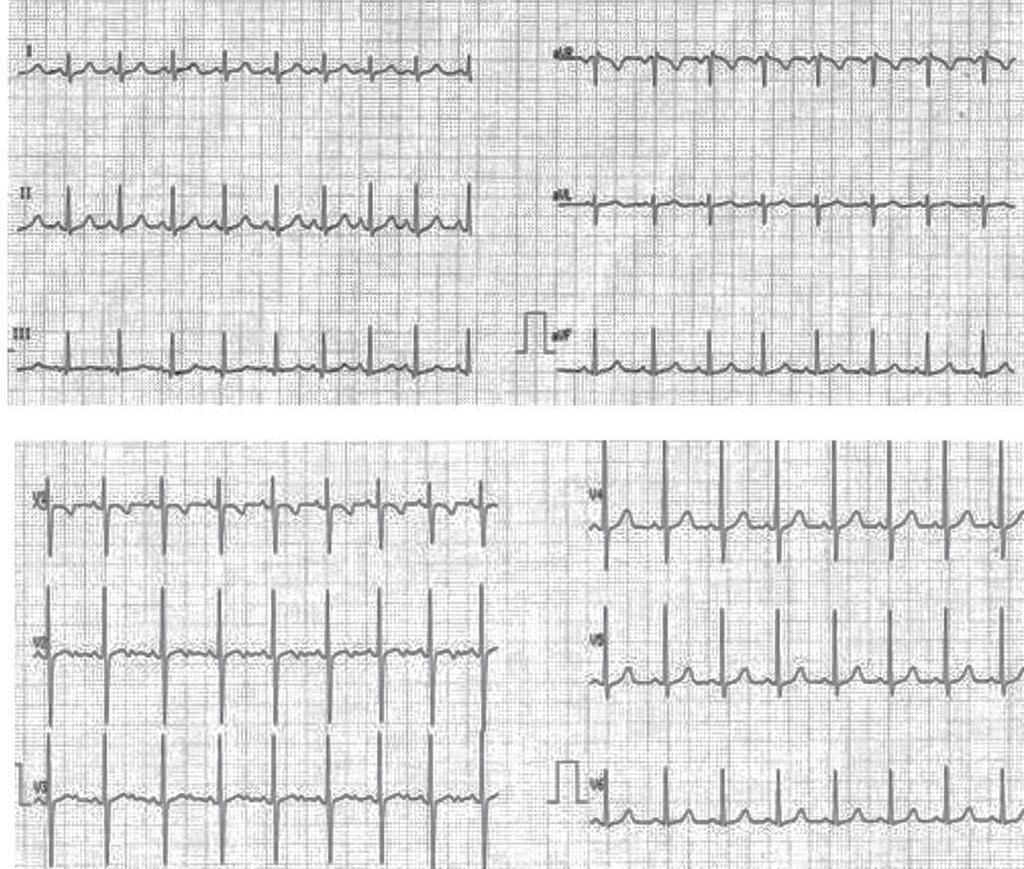 380 ROMANIAN JOURNAL OF PEDIATRICS VOL. LXIV, NO. 4, YEAR 2015 FIGURE 2. Boy of 4 years old with DMD without clinical signs of cardiac impairment. ECG: QT = 0.