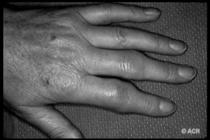 Clinical Manifestations of Rheumatoid Arthritis Extra-Articular