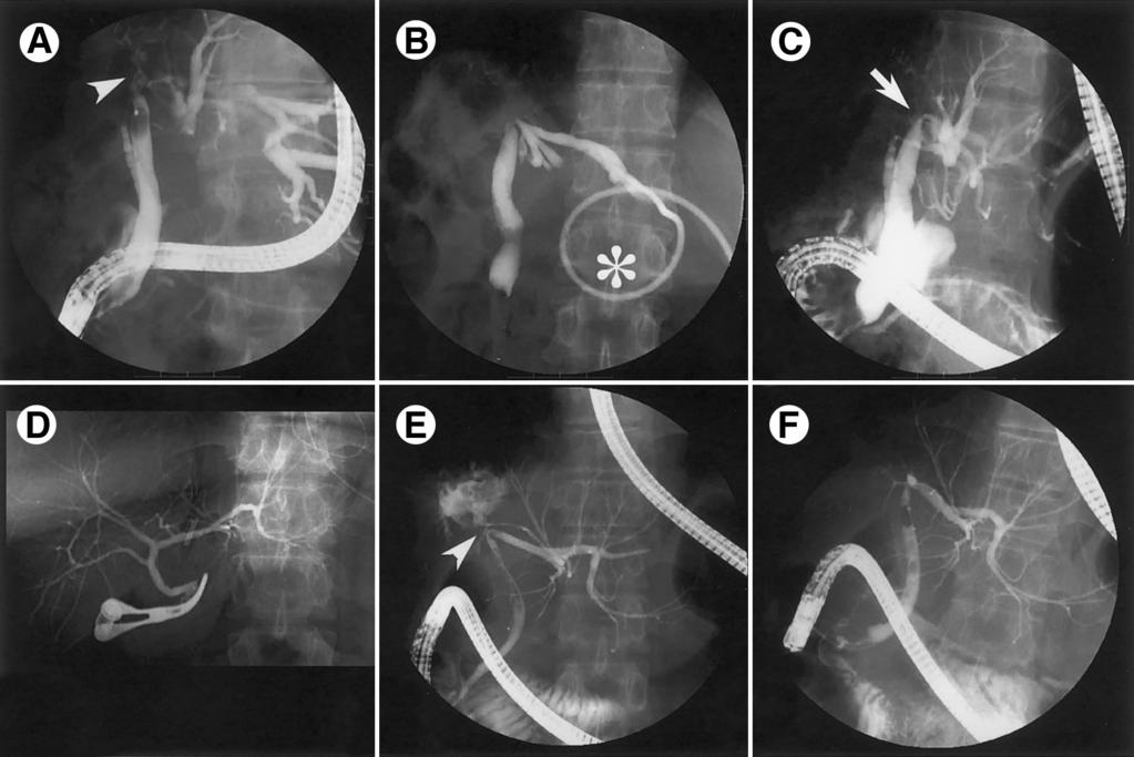 186 HASEGAWA ET AL. CLINICAL GASTROENTEROLOGY AND HEPATOLOGY Vol. 1, No. 3 Figure 2. Cholangiograms showing 2 cases of biliary stricture (A C, patient 5; D F, patient 7).