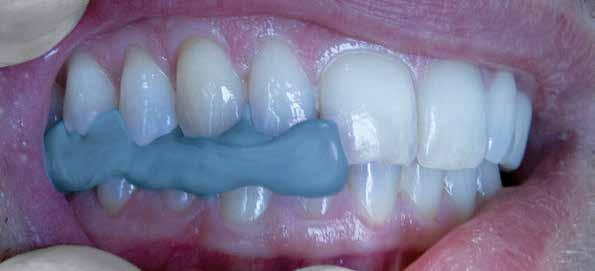 OKLUREST silicone for CAD SYSTEM bite registration OKLUREST is an addition silicone (polyvinylsiloxane) specific for orthodontic occlusion registration, registration keys for orthognatic