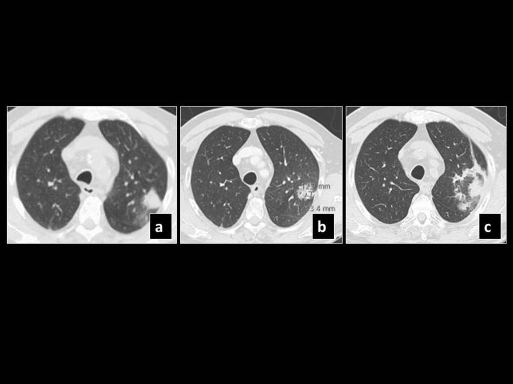 Fig. 6: Pre SBRT CT (a) shows a left upper lobe lesion, which 5 months post SBRT became more ground glass opacified (b) and 9 months later (c) it demonstrated the "orbitsign"