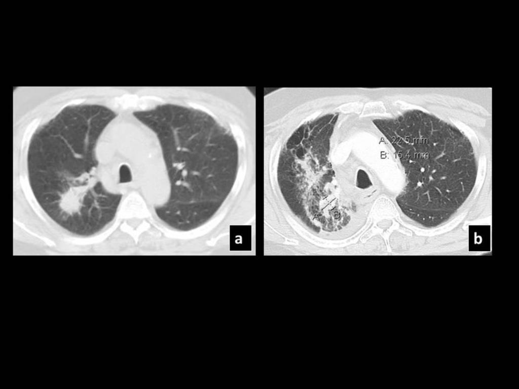 Fig. 7: Pre SBRT CT (a) shows a right upper lobe lesion, which 8 months post SBRT (b) demonstrated the "orbit-sign" characterized by the presence of
