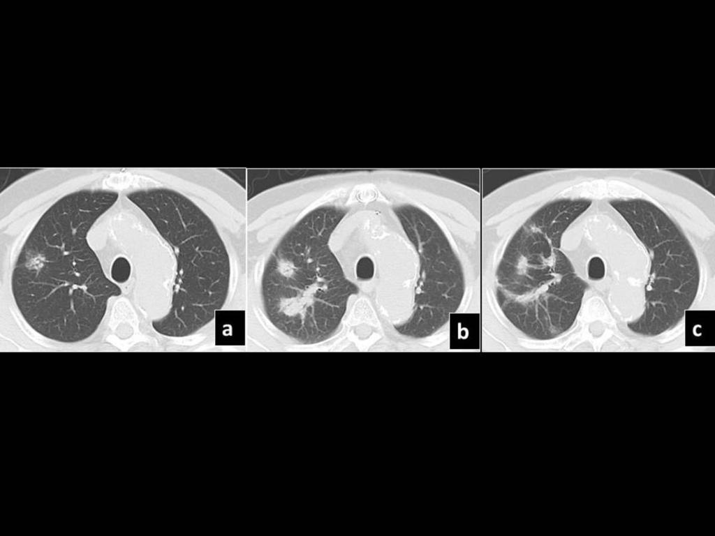 Fig. 8: Pre SBRT CT (a) shows a right upper lobe lesion, which in 6 (b) and