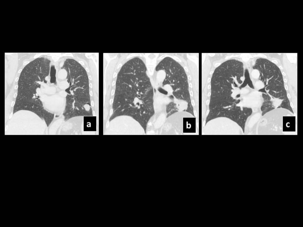 Fig. 9: Pre SBRT CT (a) shows a left lower lobe lesion, which 12 months post SBRT