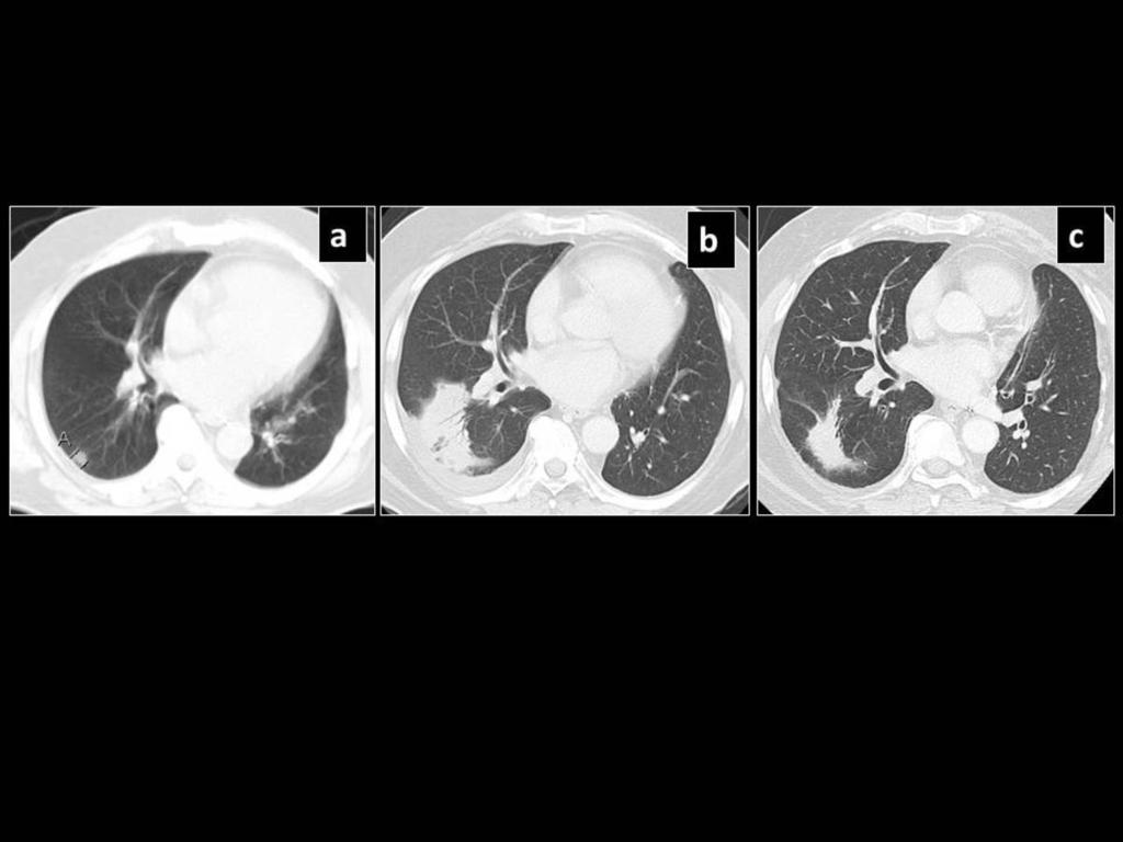 Fig. 10: Pre SBRT CT (a) shows a right lower lobe lesion, which 6 months post