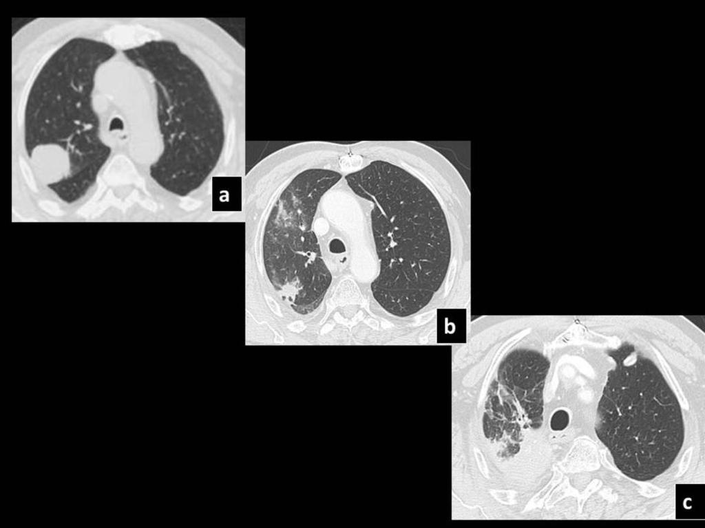 Fig. 11: Pre SBRT CT (a) shows a right upper lobe lesion, which 5 months post SBRT initially