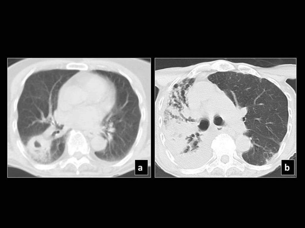 Fig. 13: Pre SBRT CT shows a right lower lobe lesion (a), which 15 months post SBRT