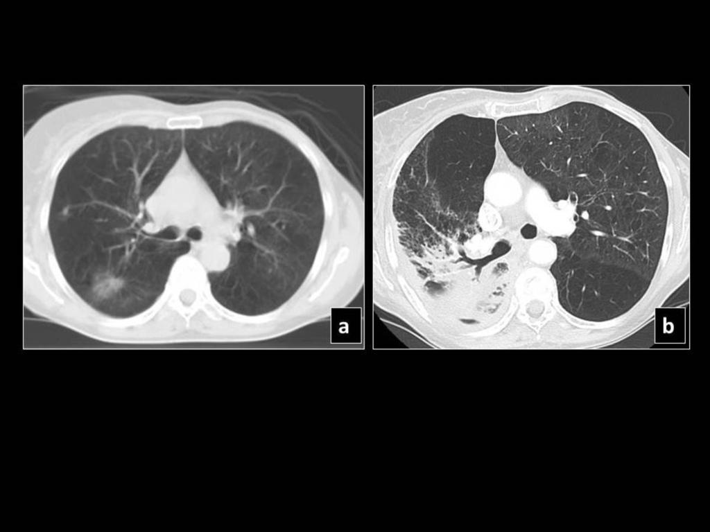 Fig. 14: Pre SBRT CT shows a right lower lobe lesion (a), which 36 months post SBRT