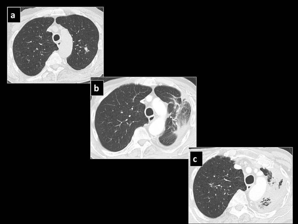 Fig. 16: Pre SBRT CT shows a left upper lobe lesion (a), which 21 months (b) and 36 months post SBRT (c)