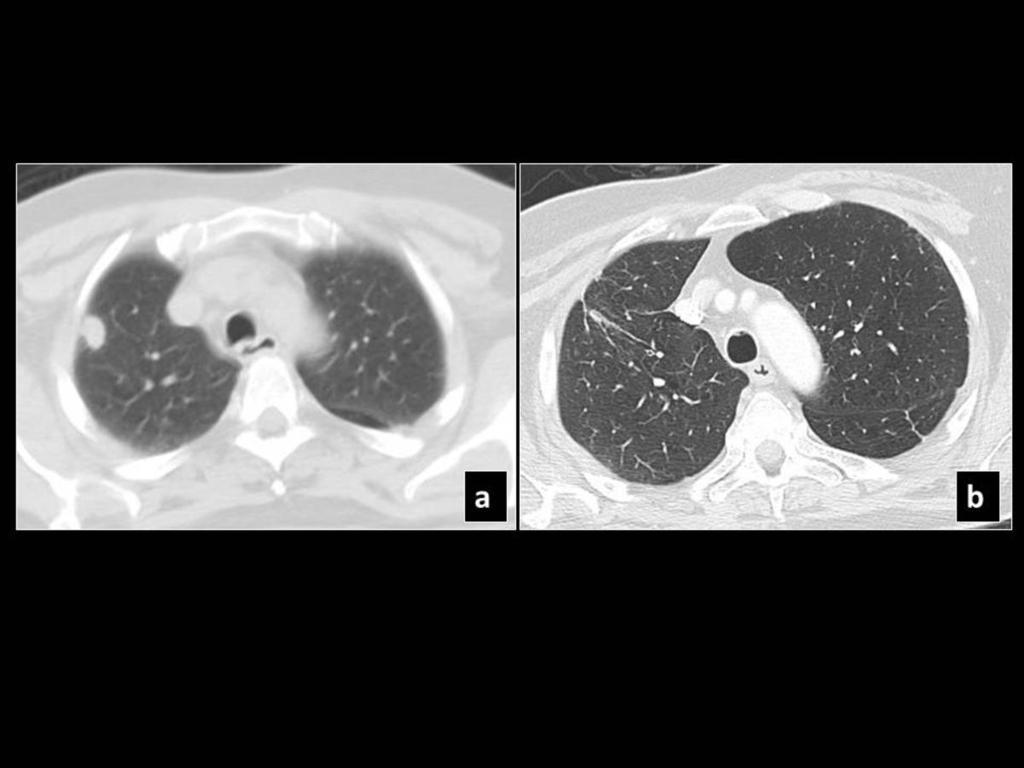 Fig. 19: Pre SBRT CT shows a right upper lobe lesion (a), which 19 months