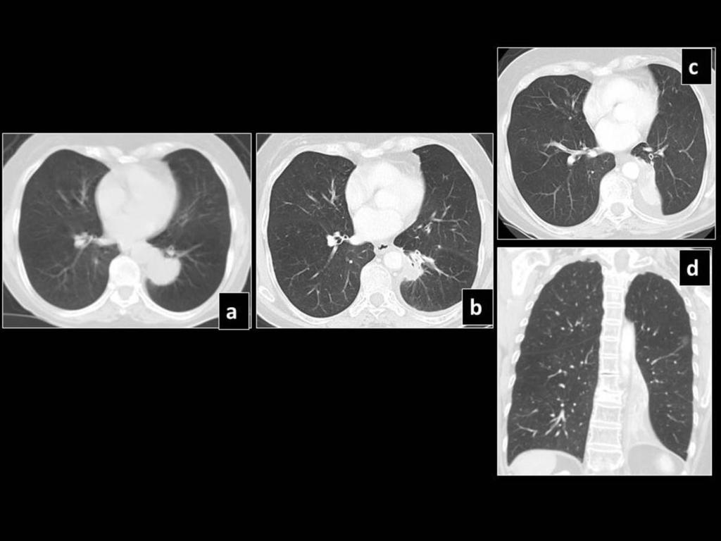 Fig. 20: Pre SBRT CT shows a left lower lobe lesion (a), which 8 months (b)
