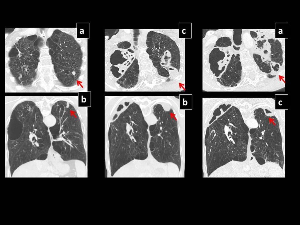 Fig. 21: Pre SBRT CT shows a left lower lobe lesion (a, b), which 24 months later increased in size