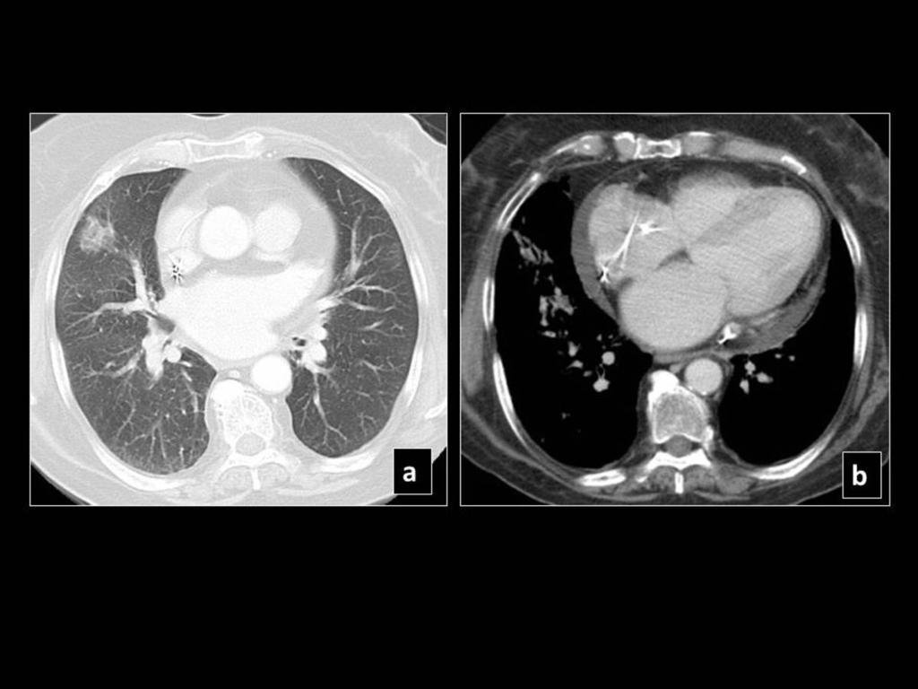 Fig. 22: Pre SBRT CT shows a middle lobe lesion (a), which 6 months later