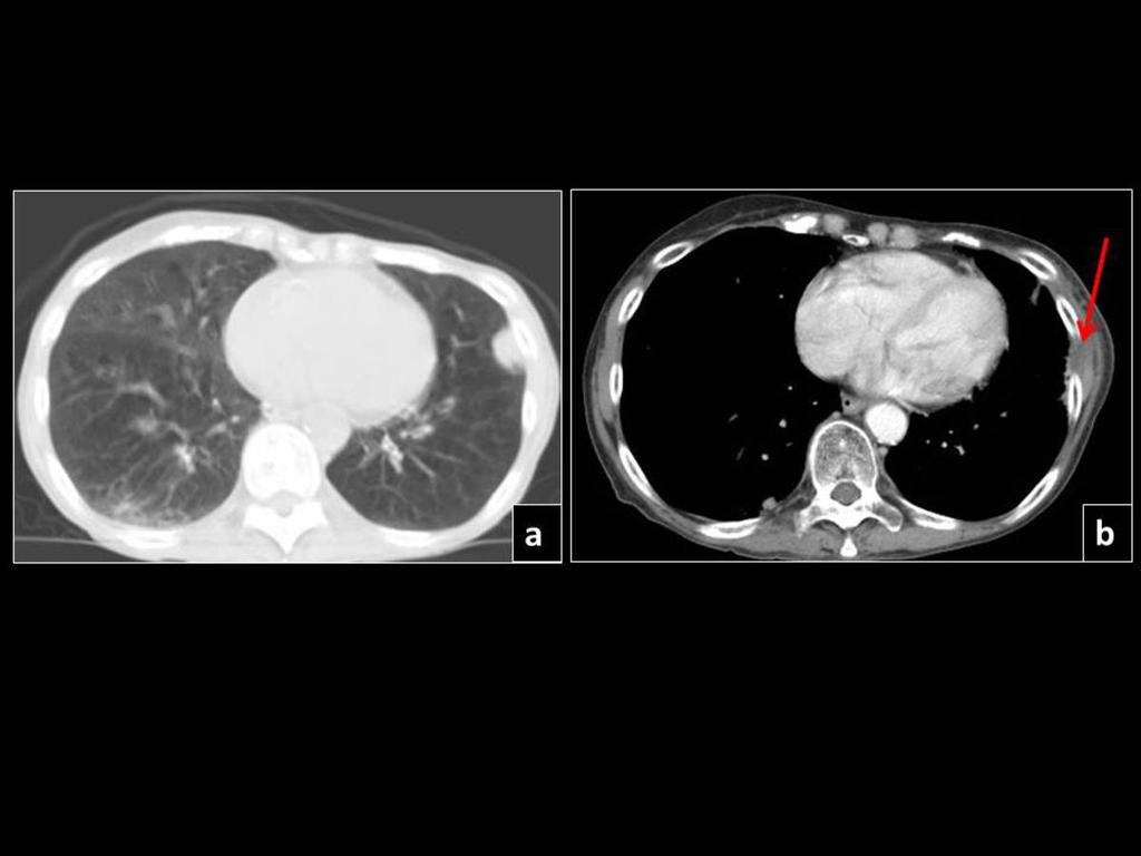Fig. 24: Pre SBRT CT shows a subpleural lingular lesion (a), which 5 months later developed toxicity of