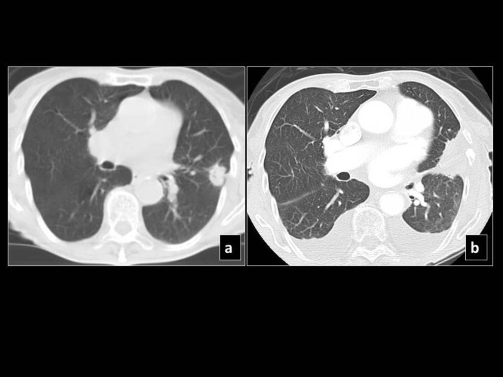 Fig. 2: Pre SBRT CT (a) shows a left upper lobe peripheral lesion which 21 months post SBRT (b) shows increase in size with a "mass-like appearance"