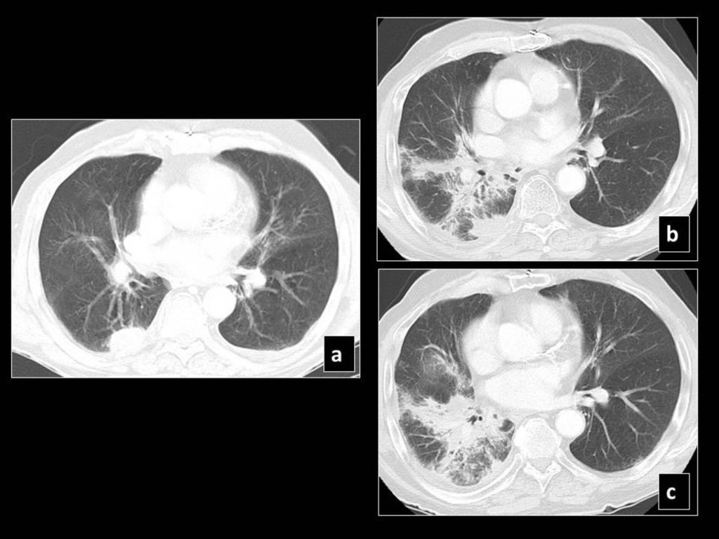 Fig. 3: Pre SBRT CT (a) shows a right lower lobe peripheral lesion, which 7 months post SBRT