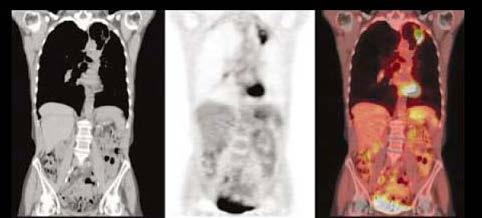 PET CT - Staging NSCLC, SCLC, Esophageal Cancer o Detects unexpected distant metastases in up to 15% o Eliminates the need for bone