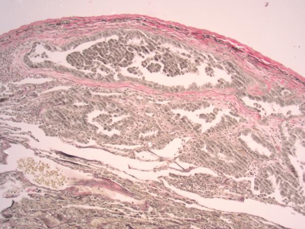 Pleural invasion Pleura layers- normal lung EVG stain PL0 Chest wall PL3 - pt3 PL2 pt2 PL1 Elastic Layer PL0 PL1 Take home point Please sample tumor abutting or involving pleura carefully.