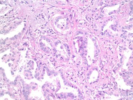of stromal, vascular, or pleural invasion Histologic variants included non-mucinous and mucinous New classification of these lesion formerly termed as bronchioloalveolar carcinoma (BAC)