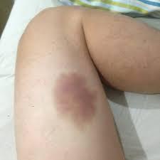 Bruises Incidence and prevalence 50% to 60% of all physical abuse cases have skin injuries, in isolation or in combination with other