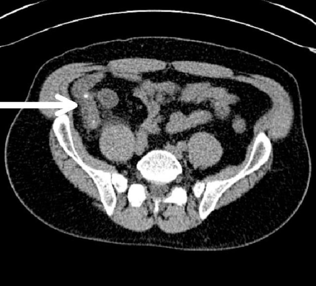 Fig. 7: Acute appendicitis.