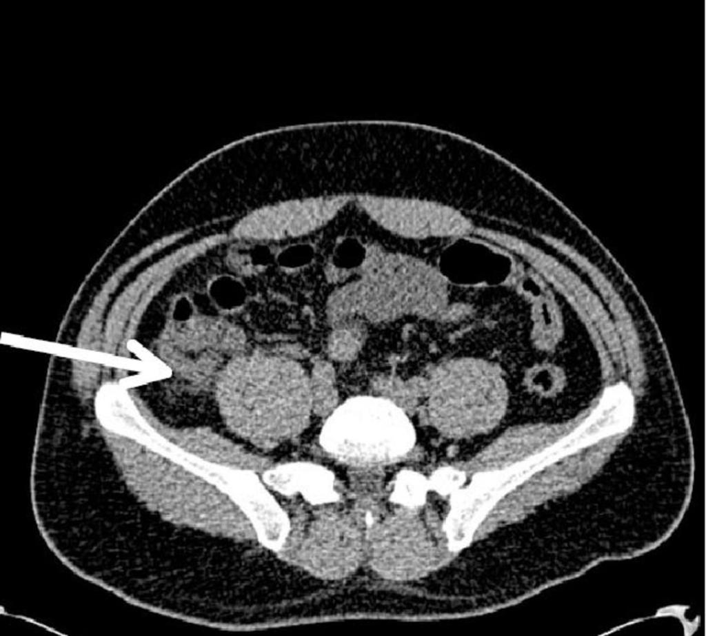 Fig. 8: Acute appendicitis.
