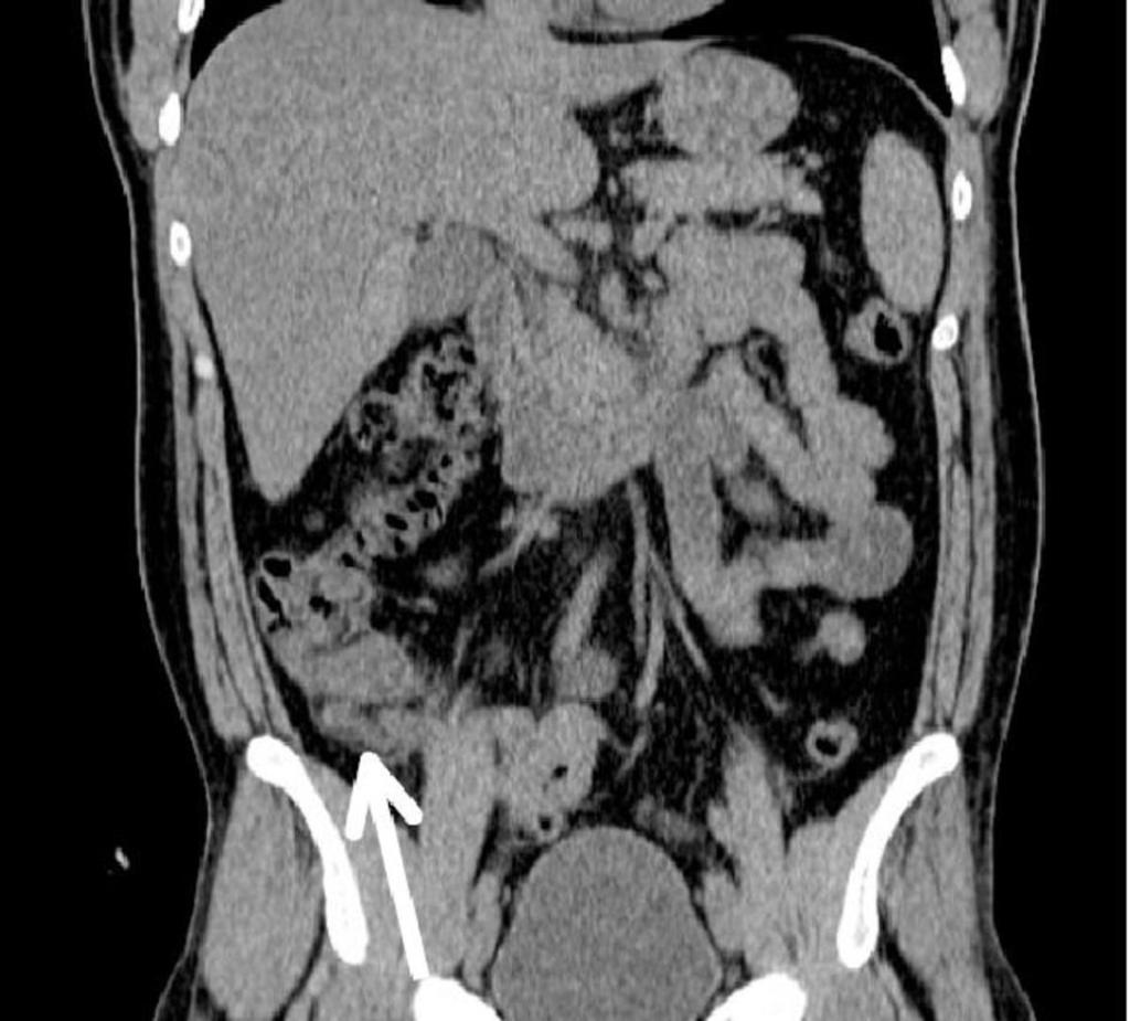 Fig. 9: Acute appendicitis on coronal