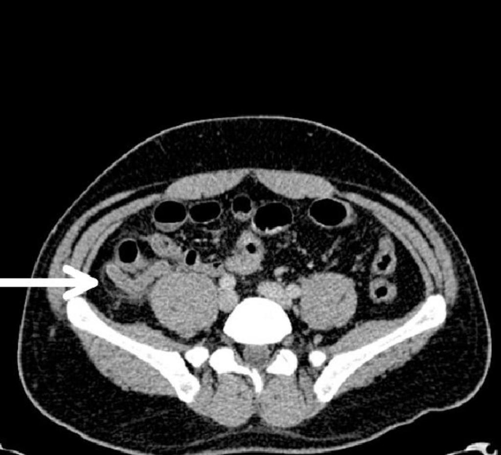 Fig. 10: Post contrast image of acute appendicitis.