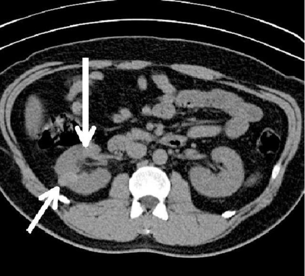 Fig. 1: Hyperdense cysts in the right kidney due to