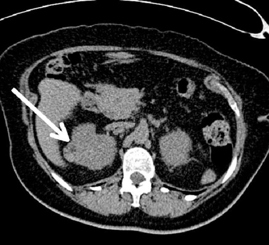 Fig. 2: Haemorrhage into an angiomyolipoma (AML) in the right kidney (white arrow).