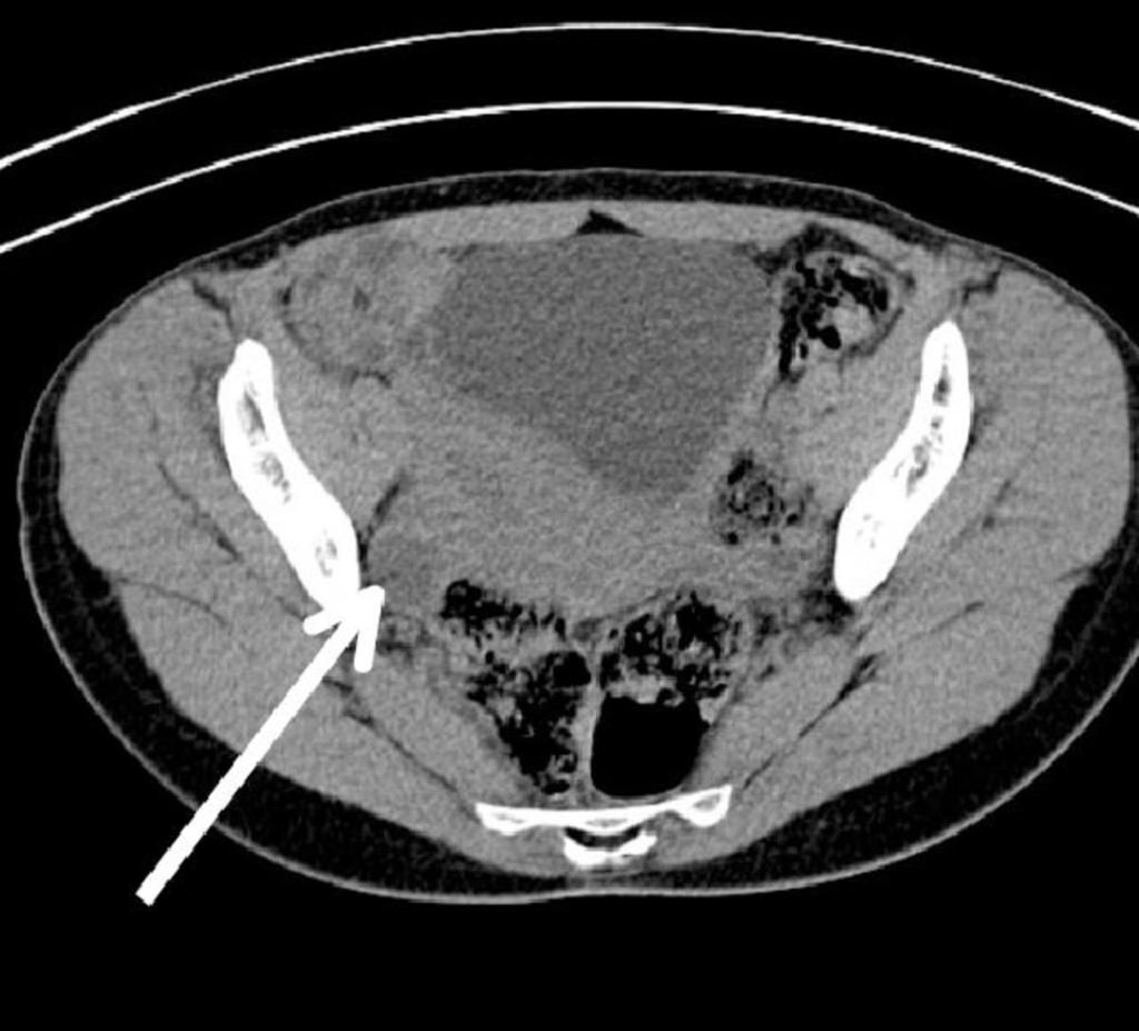 Fig. 4: A right adnexal cystic