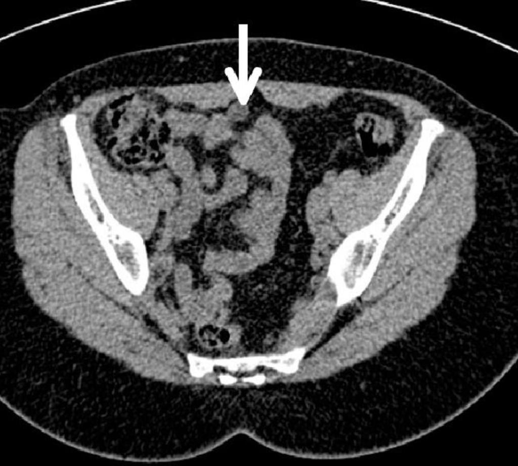 Fig. 5: A urachal cyst (white arrow). Representing a sinus remaining from the allantois during embryogenesis, a urachal cyst occurs in the remnants between the umbilicus and bladder.