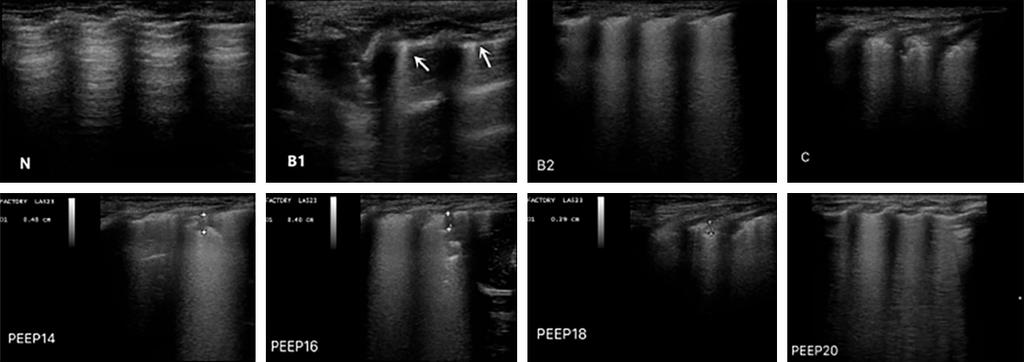 Figure 6. Example of dynamic changes in lung ultrasound manifestations in one posterior lower lung region during recruitment.