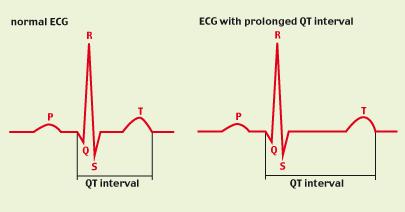 Congenital Long QT Syndrome Abnormalities of ion channels that result in long QT intervals (prolongation of phase III-time for repolarization) and predispose to polymorphous ventricular tachycardia (