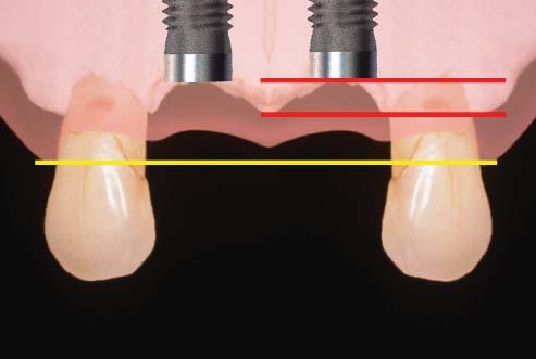 With the placement of adjacent implants, papillary height between the implants changes from 4.5 mm to between 3.0 and 3.5 mm above the bone.