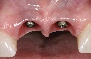 central incisor implants should remain within 1.0 to 2.0 mm of the preextraction papillary level if the clinician places the implants 3.