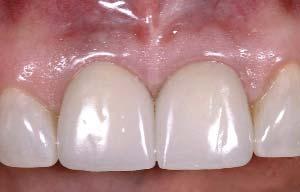 Since the interproximal bone between the extracted central incisors most likely will be lost, the risk of soft-tissue recession in the area in which a papilla needs to be created between central