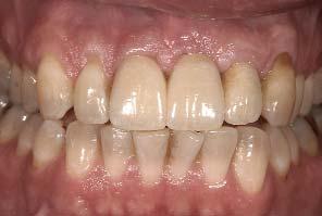 When periodontal disease is present, the bone does not always respond as it would if it were healthy, which often leads to greater resorption of bone and a greater degree of papillary recession.