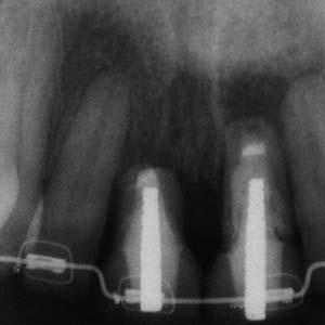 15 Although eruption of a single tooth that is to be ex - tracted does not alter the final papillary heights, because those heights are dictated by the bone on the adjacent teeth, the eruption of