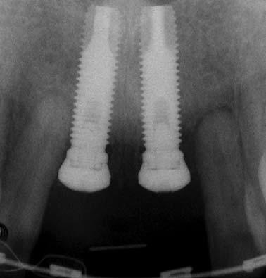 This movement of the bone is not highly predictable, however, so the clinician must inform the patient that a perfect esthetic result is unlikely and that short papillae, long contacts and more