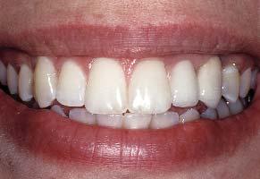the restorations; and the patient s esthetic concerns, demands and expectations will lead the dentist and the patient through a therapeutic decision tree, each branch requiring a choice.