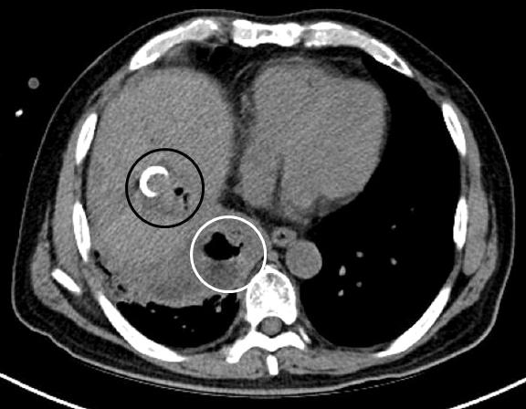 A computed tomography scan obtained two weeks after radiofrequency ablation shows that the previously ablated area has become hypodense with area formation, which was identified as a liver abscess