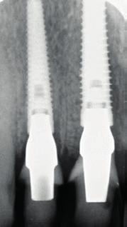 Implant placement Immediate placement of two NobelReplace Conical Connection implants (3.