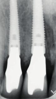 3 16 mm) at buccal crestal bone level, in order to create mesial and distal bone peaks for